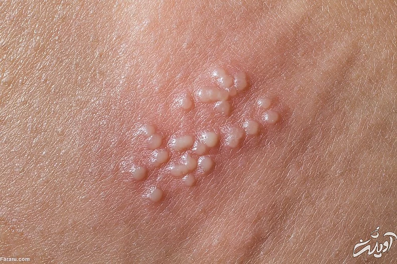 بیماریهای مقاربتی و تمام آنچه که باید بدانید! مقاربتی